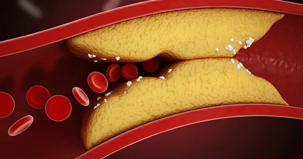 Médico vascular explica o que realmente ajuda a reduzir a gordura nas artérias e proteger o coração