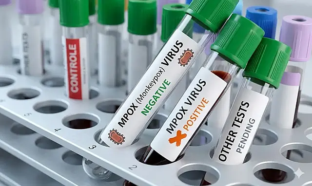 Casos de Mpox em 2026 chegam a 140 no Brasil, sem mortes.
