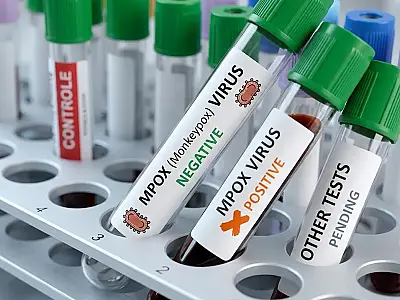 Casos de Mpox em 2026 chegam a 140 no Brasil, sem mortes.