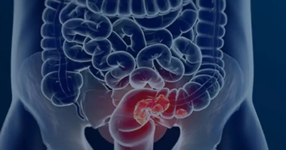 Rastreamento do câncer colorretal avança no SUS e pode ampliar diagnóstico precoce e prevenção no país