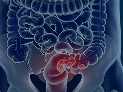 Nova diretriz para rastreamento do câncer colorretal no SUS avança com apoio da Conitec e pode ampliar prevenção, diagnóstico precoce e tratamento.