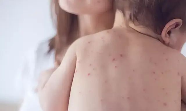 Profissional de saúde prepara dose da vacina tríplice viral em unidade básica de saúde de São Paulo.
